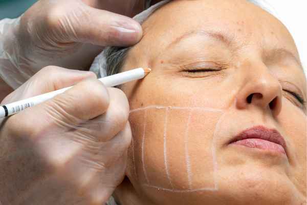 CryoPen: 5 Skin Concerns It May Be Used to Treat 4 What should you ask before having CryoPen treatment Burley?