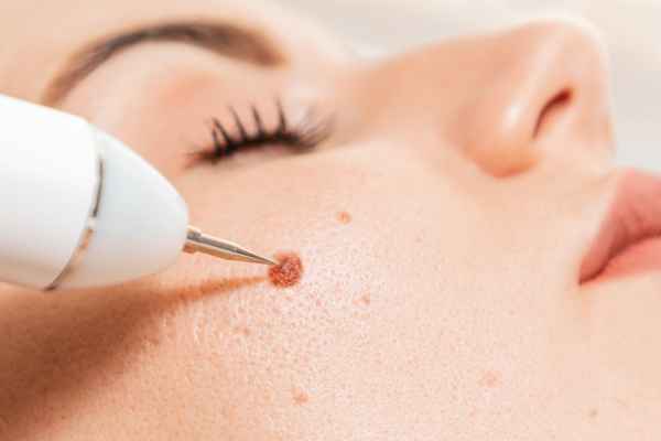 CryoPen: 5 Skin Concerns It May Be Used to Treat 3 What actually happens during a CryoPen treatment Burley?