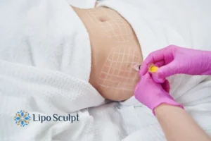 Are The Results From Aqualyx Permanent? 1 Do you want to know how long Aqualyx Burley results last?