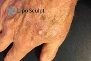 Best Actinic Keratoses Removal 2 Improve your wellbeing and health with Actinic Keratoses Burley removal.treatment