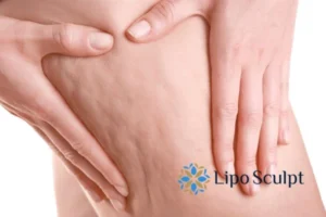 CoolSculpting for Legs: The Innovative Approach to Redefining Your Legs 5 Start your journey today book your coolsculpting treatment Burley online today!